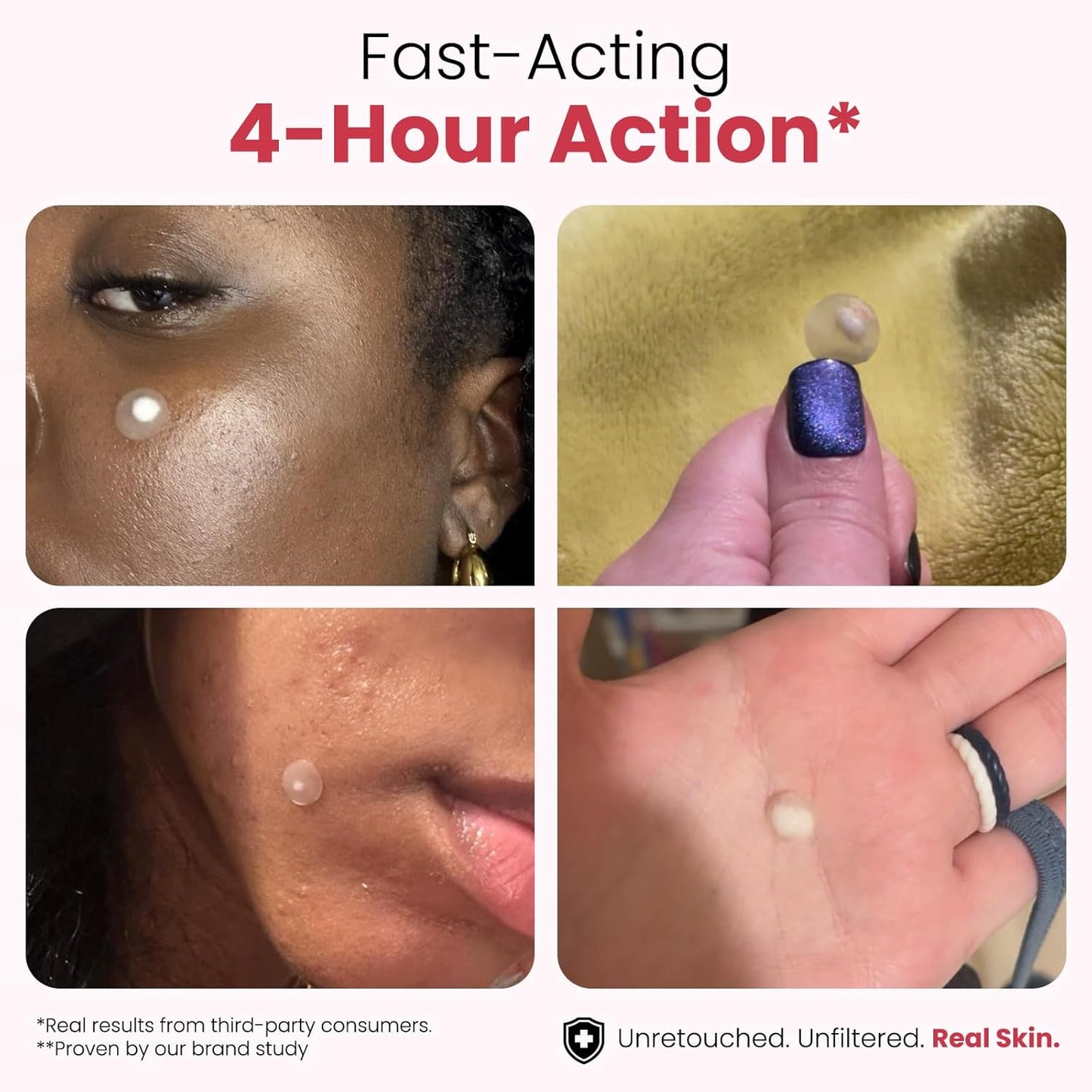 ROSELYNBOUTIQUE Pimple Patches for Face 300 Counts 4 Sizes Hydrocolloid Acne Patches with Tea Tree Oil,Zits Blemishes Pore Strips - Vegan Facial Skin Care Products Cruelty-Free