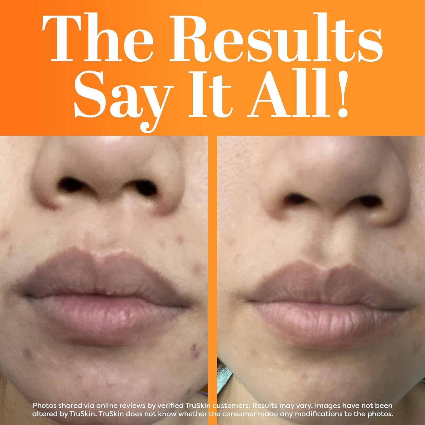 Truskin Vitamin C Serum for Face – anti Aging Face Serum with Vitamin C, Hyaluronic Acid, Vitamin E – Brightening Formula – Improve Appearance of Dark Spots, Tone, Fine Lines & Wrinkles, 2 Fl Oz